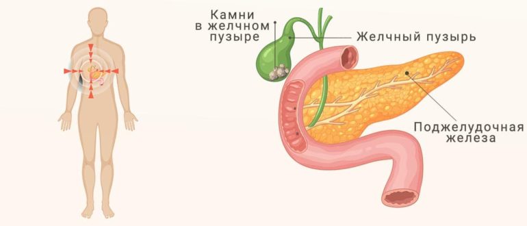 Камни в желчном пузыре — расположение на схеме.