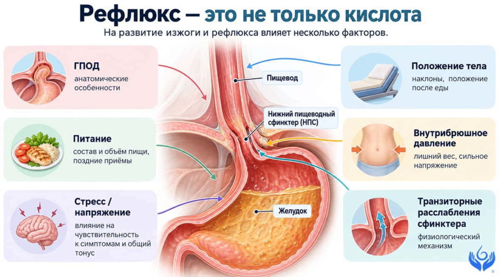 Анатомическая схема пищевода, нижнего пищеводного сфинктера и желудка с факторами рефлюкса: ГПОД, питание, положение тела, внутрибрюшное давление и стресс